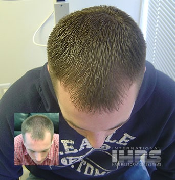 Laser Hair Regrowth - All You Need to Know - Hair Replacement Restoration | Hair Loss Treatment | Jacksonville, FL Laser Hair Regrowth - All You Need to Know - Hair Replacement Restoration | Hair Loss Treatment | Jacksonville, FL