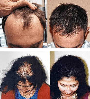 Hair Transplants - Medical Hair Restoration - Jacksonville FL
