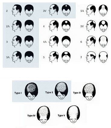 Norwood Ludwig Hair Loss Scale