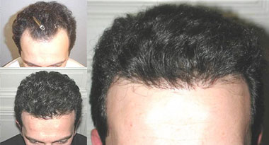 Jacksonville Hair Teransplant surgeon