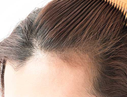What Is Alopecia Areata? What Hair Loss Solutions Work?