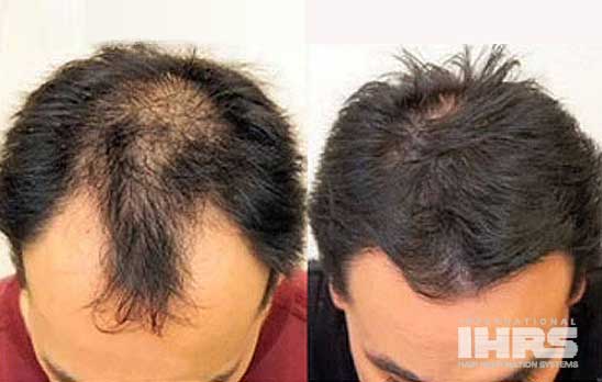 Men's Hair Transplant Clinic & Hair Restoration Florida