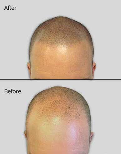 Scalp Micropigmentation for thinning hair - Jacksonville, FL