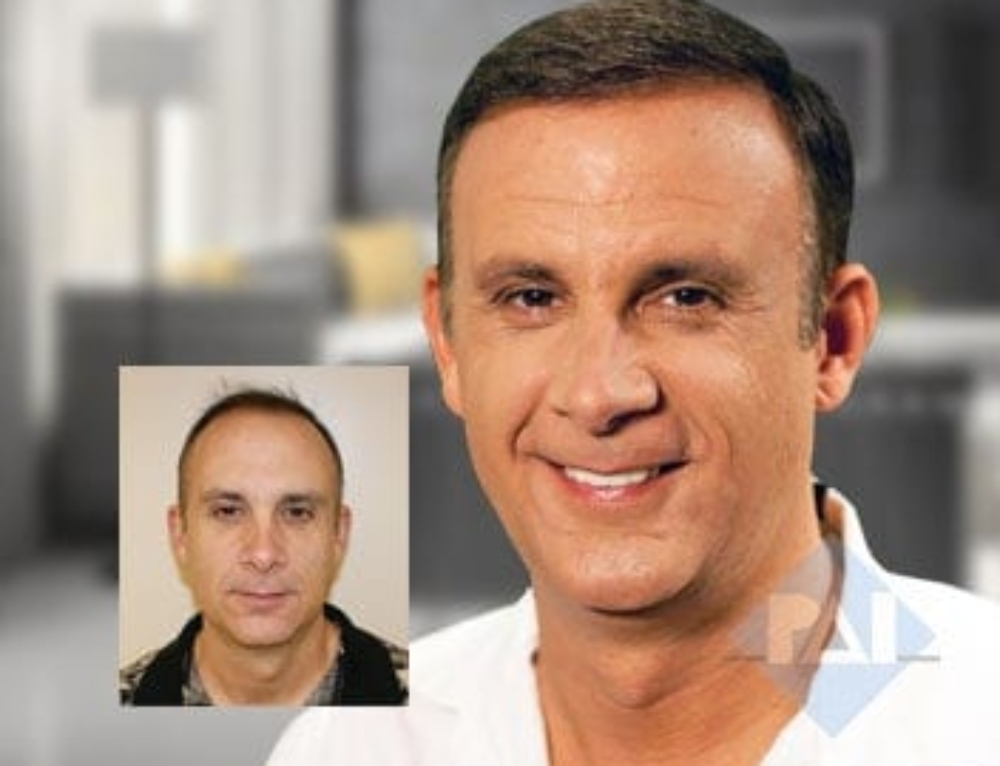 Hair Transplant Surgery Aftercare 7 Basic Steps Hair Replacement