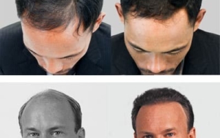 Neograft FUE Hair Transplants Jacksonville FL