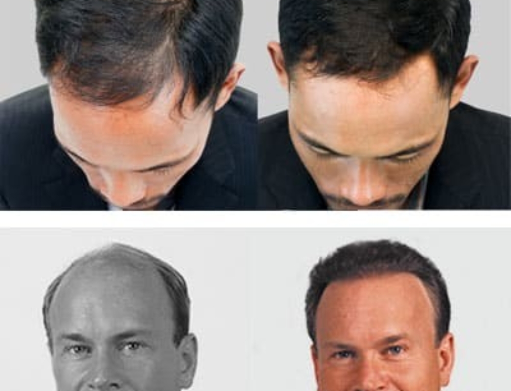 Hair Transplant Surgery Aftercare 7 Basic Steps Hair Replacement