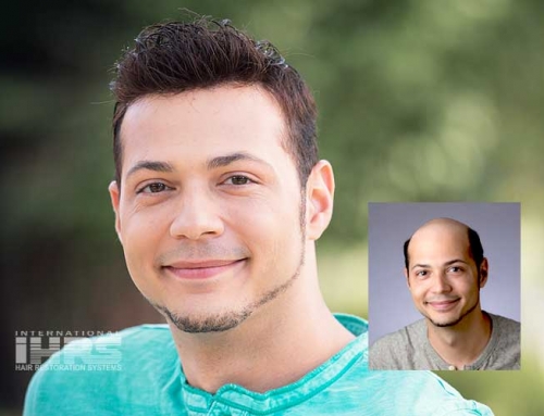 Restore Your Hair and Your Life with IHRS Hair Restoration Systems