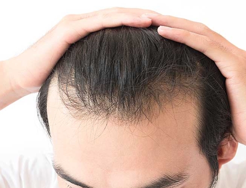 Is a Second Hair Transplant Possible?